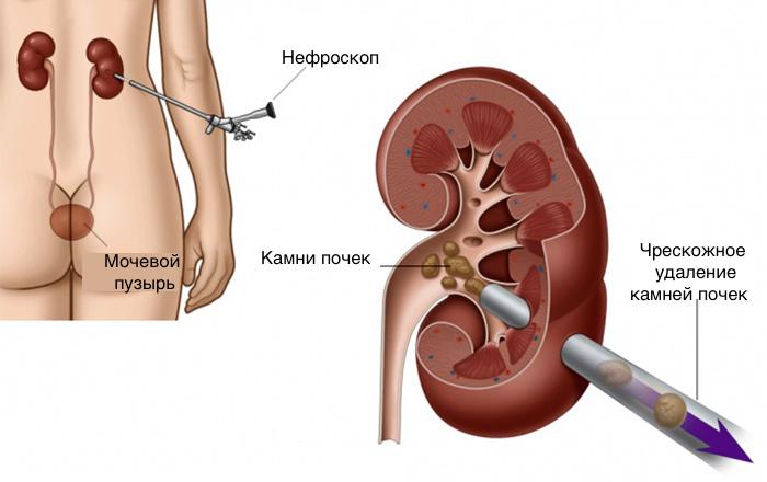 Лечение почечных камней